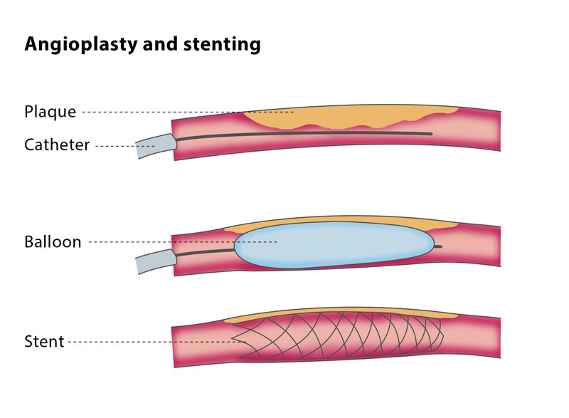 Замена стентов. Баллонная ангиопластика коронарных артерий. Чрескожная коронарная баллонная ангиопластика. Баллонная ангиопластика и стентирование артерий сердца. Коронарная ангиопластика и стентирование.