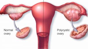 polycystic-ovary-syndrome-pcos