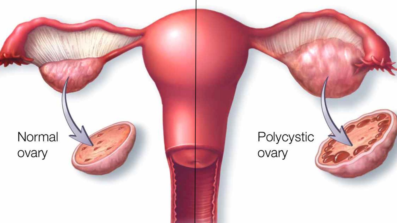 Polycystic Ovary Syndrome Expert Chikitsa