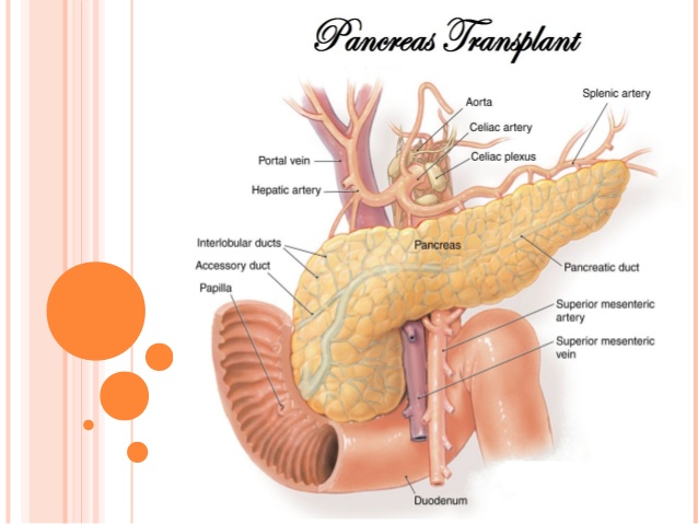 pancreas transplant