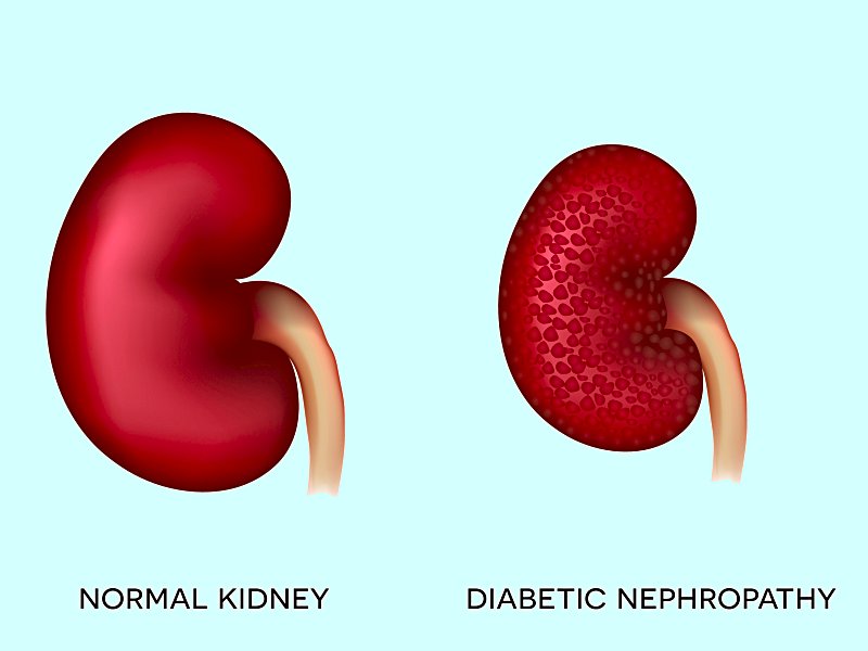 diabetic_nephropathy