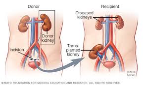 Kidney Transplant - Best Hospitals in India