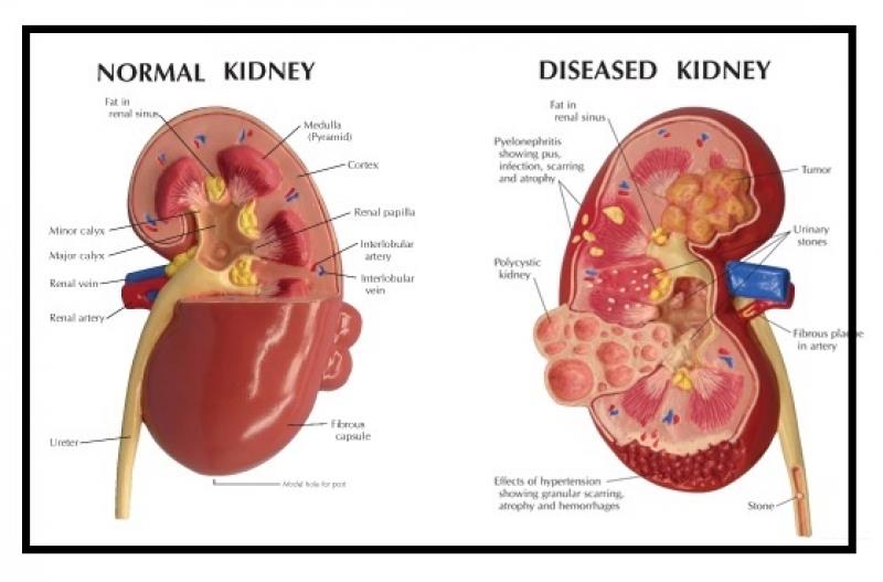 Normal vs Diseased Kidney