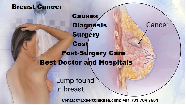Breast Cancer Symptoms, Diagnosis, Treatment, Cost and Post-Surgery care