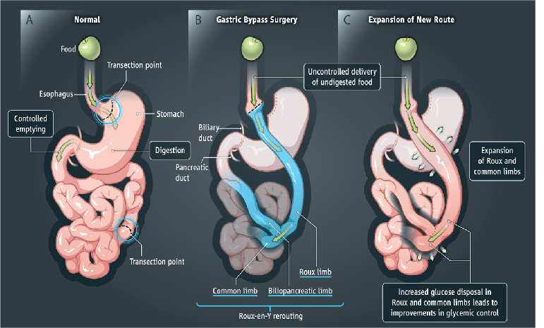 GBP - Gastric Bypass Surgery : Best Doctor and Hospital for surgery, Cost for GBP, Precautions, Process, Success Rate and Recovery. Leading GBP surgeons second opinion and Tele-Consultation
