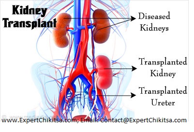 Kidney Transplant Cost, Kidney Transplant Process, Kidney Transplant Documents, Kidney Transplant Donor, Kidney Transplant Surgery, Kidney Transplant non relative, Kidney Transplant legal