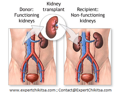 Kidney Transplant in India Cost, Kidney Transplant Process In India, Kidney Transplant Donor