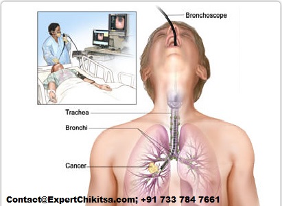lung cancer symptoms , throat cancer symptoms, Lung Cancer Best Doctor, Lung cancer treatment, Lung Cancer Treatment Cost