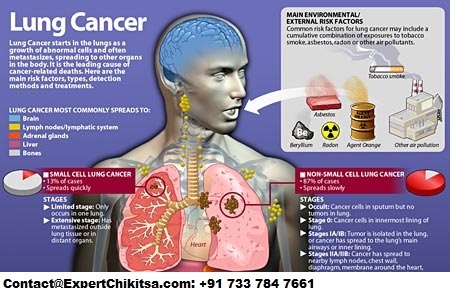 lung cancer symptoms , throat cancer symptoms, Lung Cancer Best Doctor, Lung cancer treatment, Lung Cancer Treatment Cost