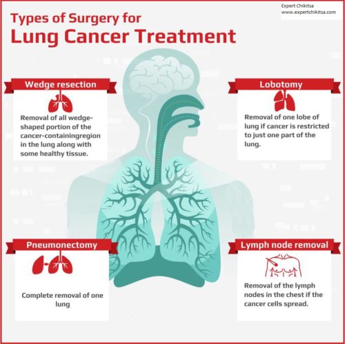 Lung Cancer Treatment and Surgery Cost in India - Expert Chikitsa