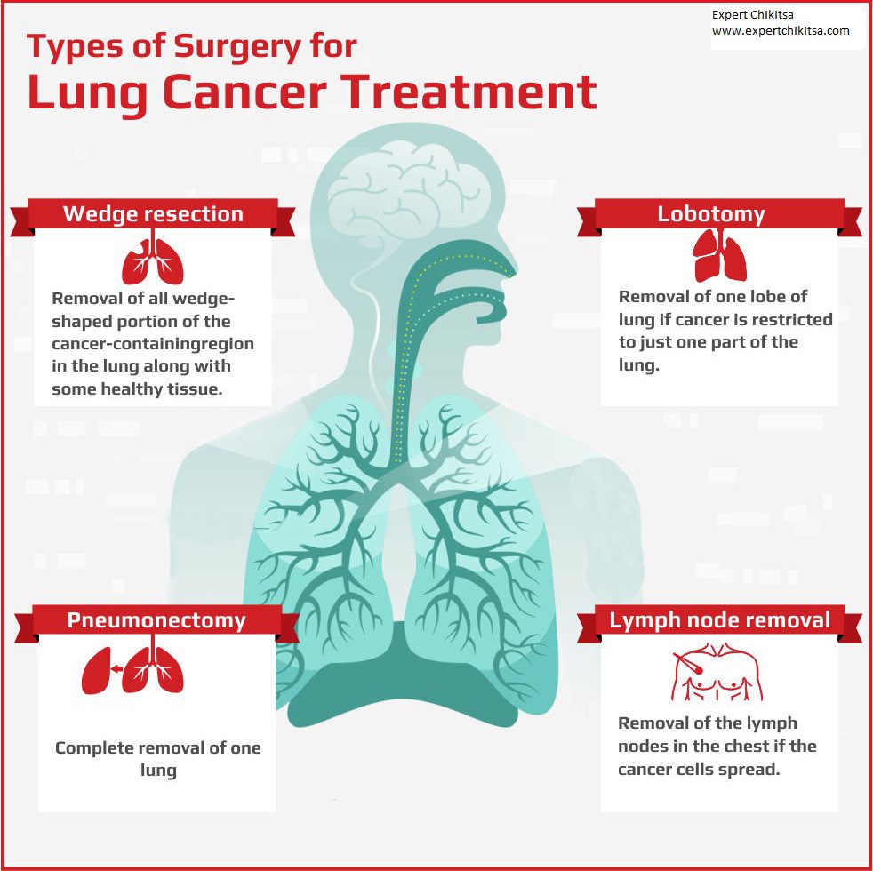Lung Cancer Treatment and Cost