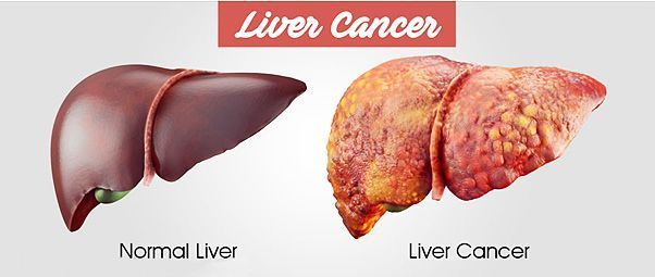 Best Liver Cancer Hospitals in India