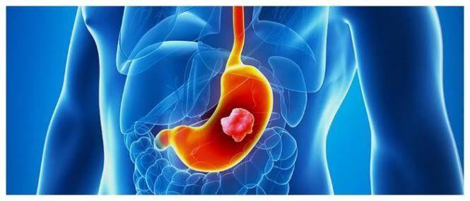 Best Stomach Cancer Hospital in India