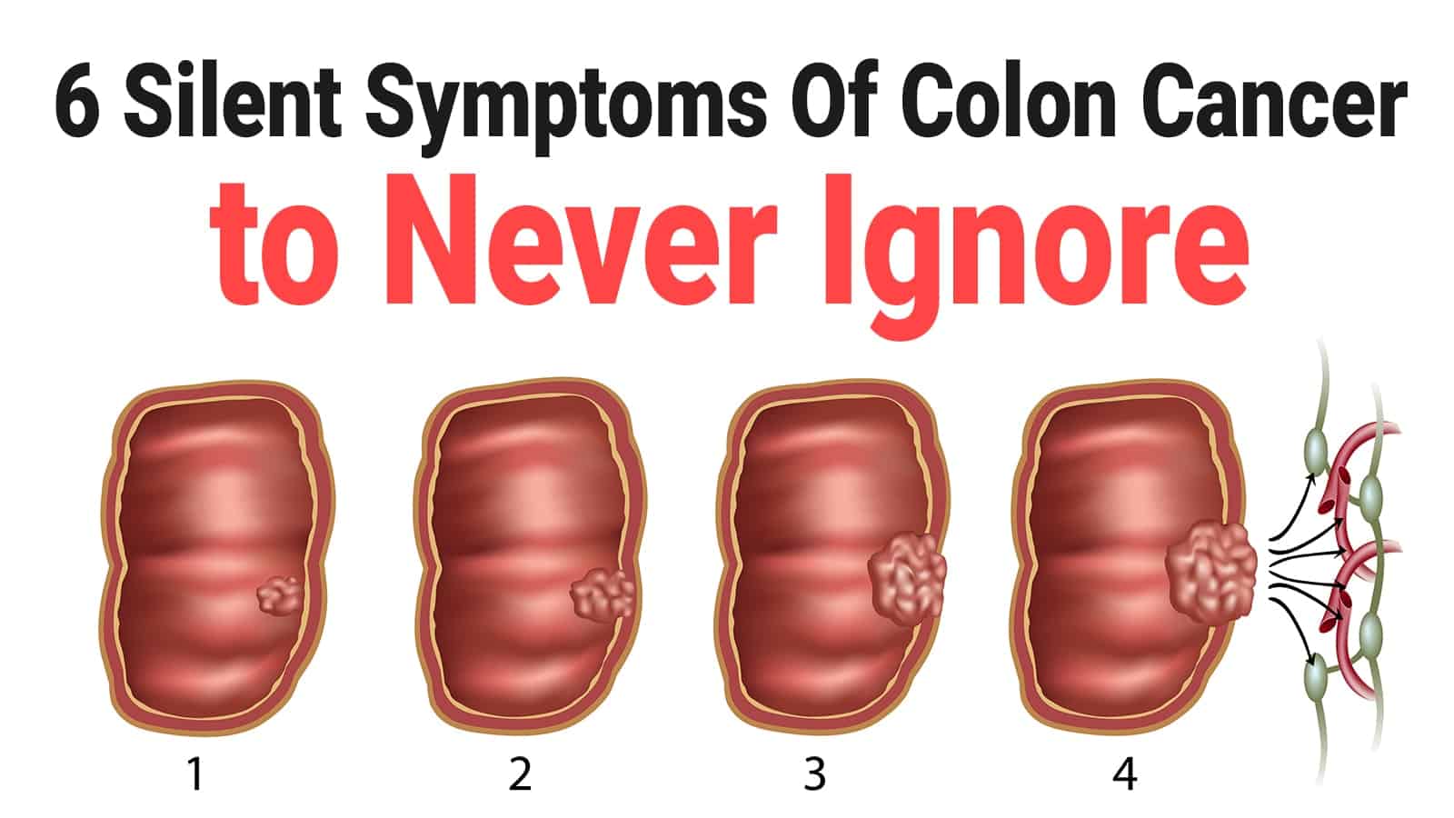 Best Colon Cancer Hospitals in India