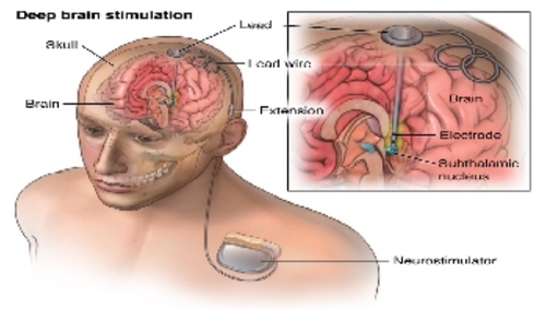 Best Deep Brain Stimulation Surgeon in India,