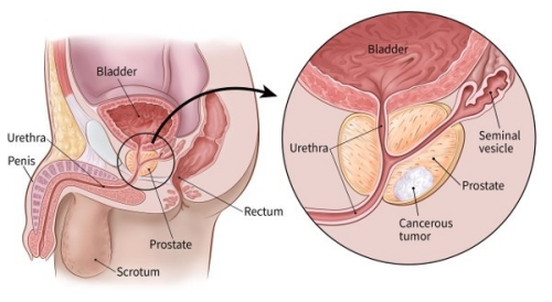 Best Prostate Cancer Hospitals in India
