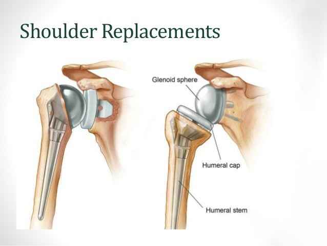 Best Shoulder Replacement Surgeon in India