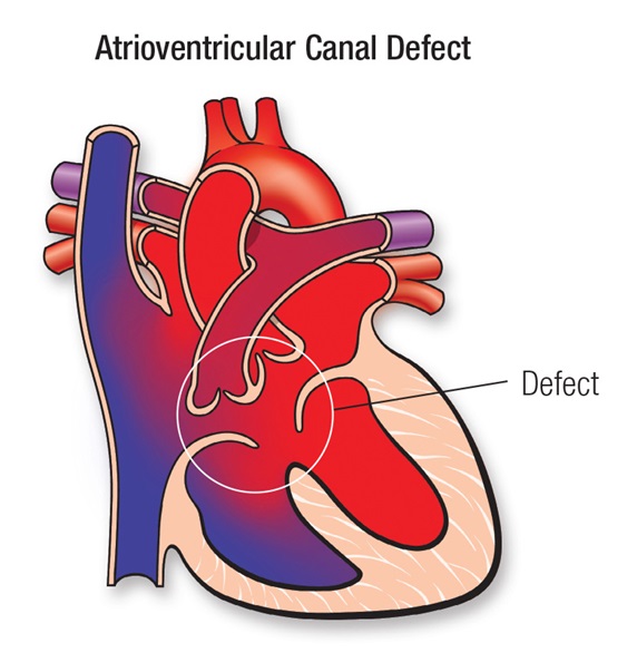 AV - Atrioventricular Canal Surgery Cost In India - Expert Chikitsa