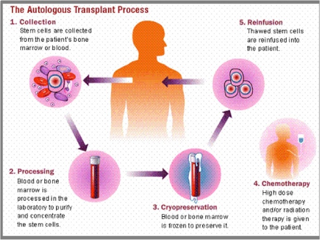 Autologous Bone Marrow Transplant Surgery Cost In India - Expert Chikitsa