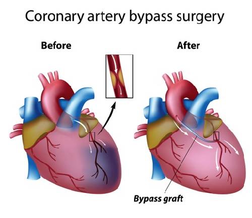 Off Pump Cabg Surgery Cost In India