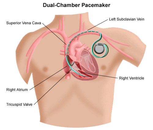 Single vs double chamber pacemaker