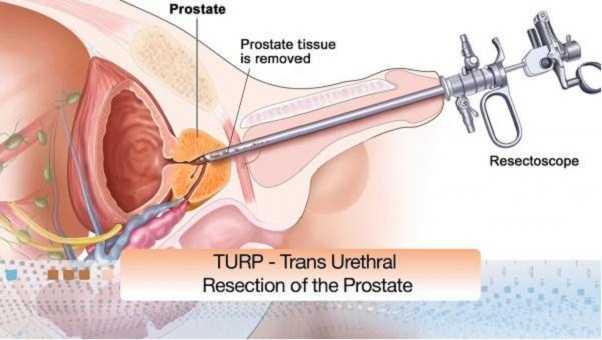 laser prostate surgery cost in india infecții urinare la bărbați