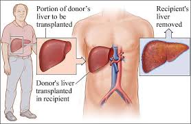 Split type Liver Transplant cost in India