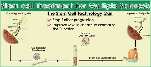 Multiple Sclerosis Stem Cell Therapy Hospitals in India