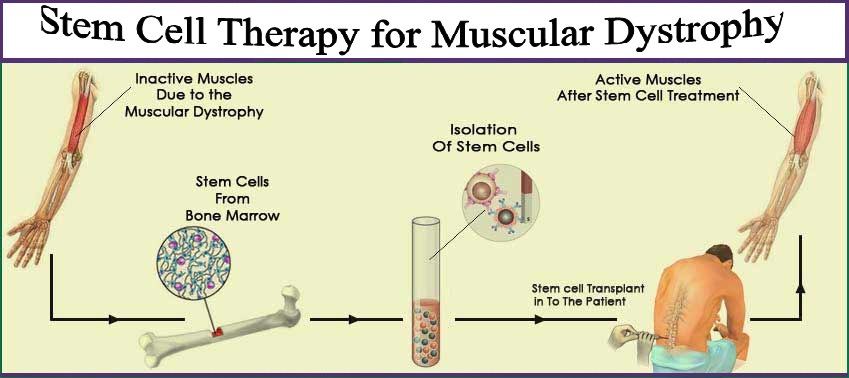 Muscular Dystrophy Stem Cell Therapy Hospitals in India