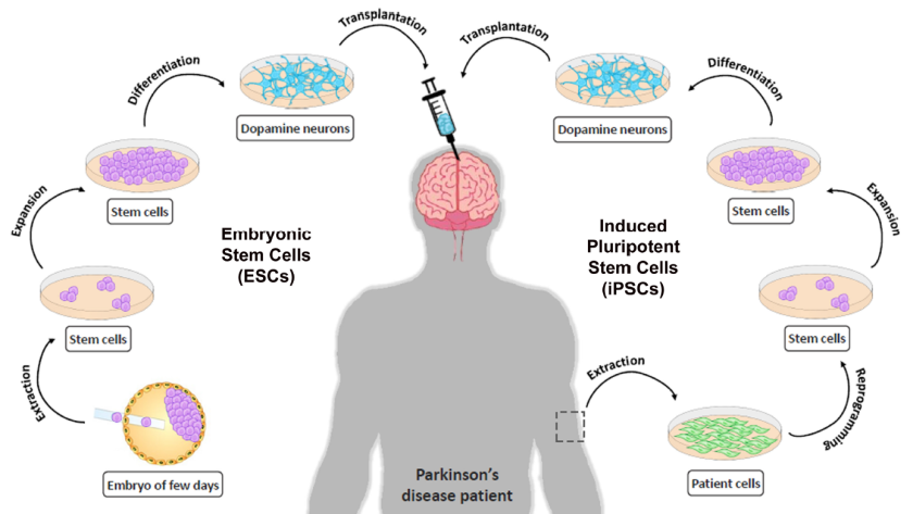 Parkinson’s Disease Stem Cell Therapy Hospitals in India