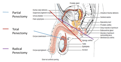 Penectomy Videos