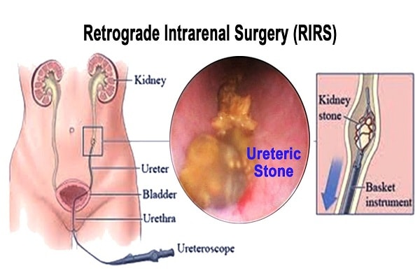 Rirs Retrograde Intrarenal Surgery Cost In India