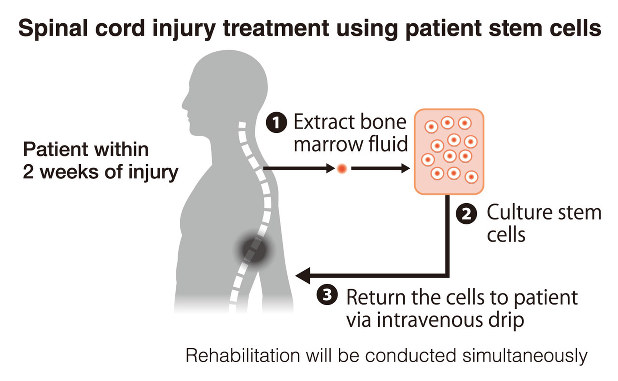 Spinal Cord Injury Stem Cell Therapy Hospitals in India