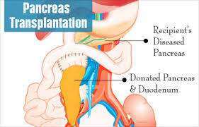 pancreas transplant in India
