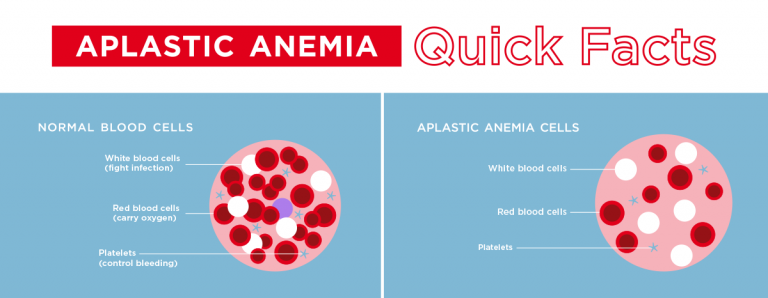 Aplastic Anemia in Turkey – Find Cost Estimate, Reviews and Book Appointment