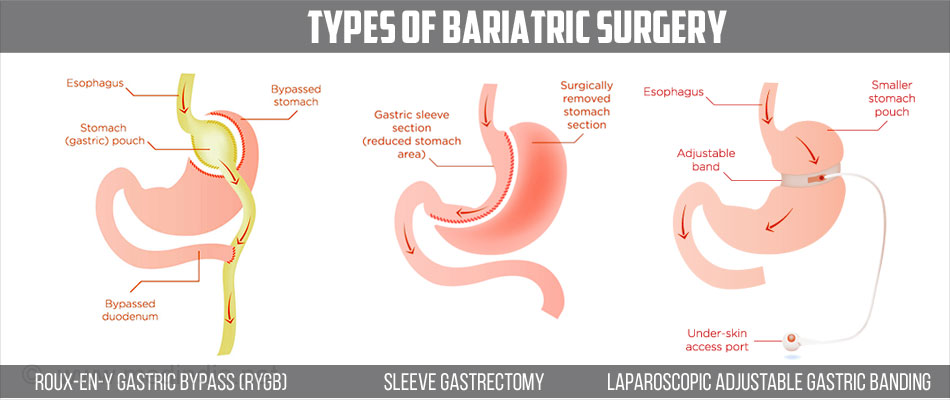 Bariatric Surgery in Turkey – Find Best Hospitals, Cost Estimate, Reviews