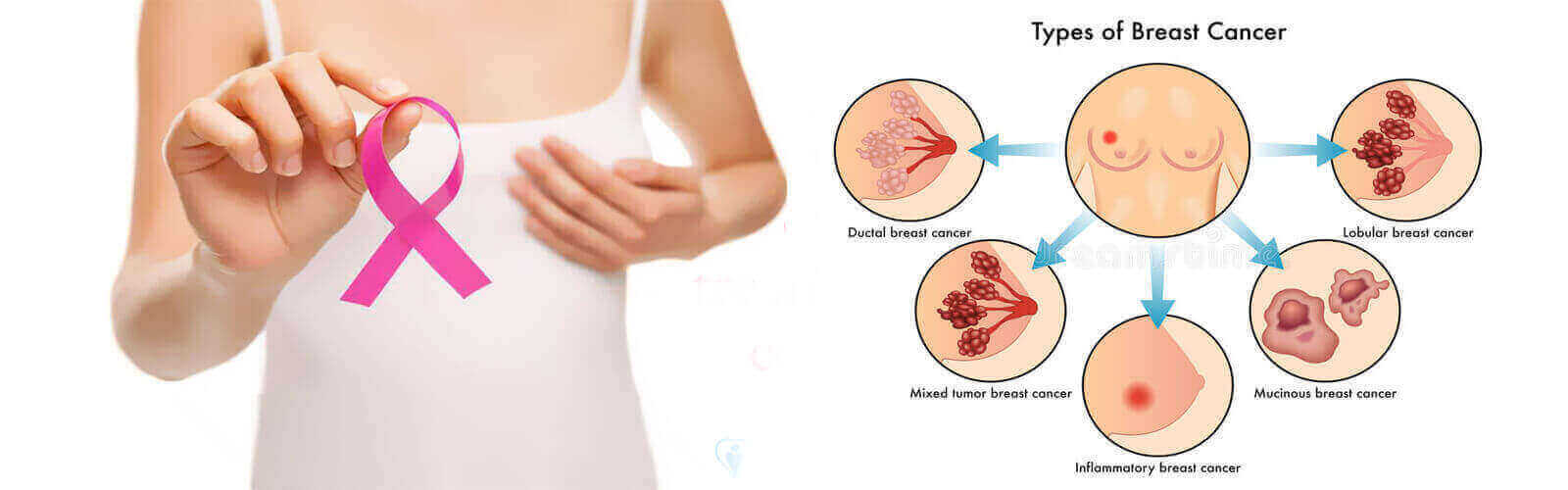 Breast Cancer Treatment in Turkey – Find Cost Estimate, Best Hospitals and Book Appointment