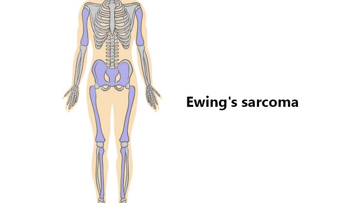 Ewings Sarcoma in Turkey – Find Cost Estimate, Reviews and Book Appointment