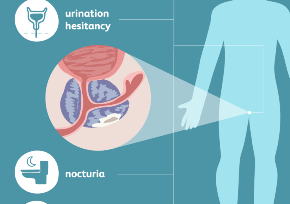 Prostate Cancer Treatment In Turkey Find Best Hospitals Cost Estimate And Book Appointment