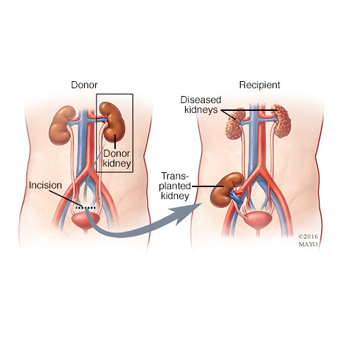 Kidney Transplant in Dhaka – Find Reviews, Cost Estimate and Book Appointment