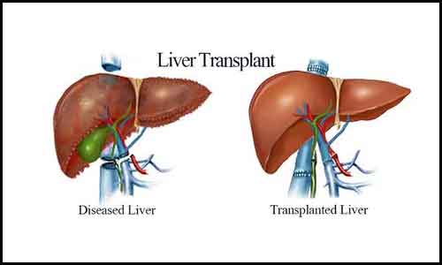 Liver Transplant in Dhaka – Find Reviews, Cost Estimate and Book Appointment