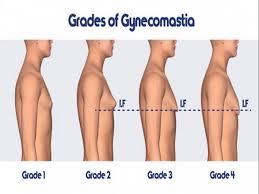 Gynecomastia Surgery Cost in Bangalore – Find Best Surgeons, Reviews and Book Appointment