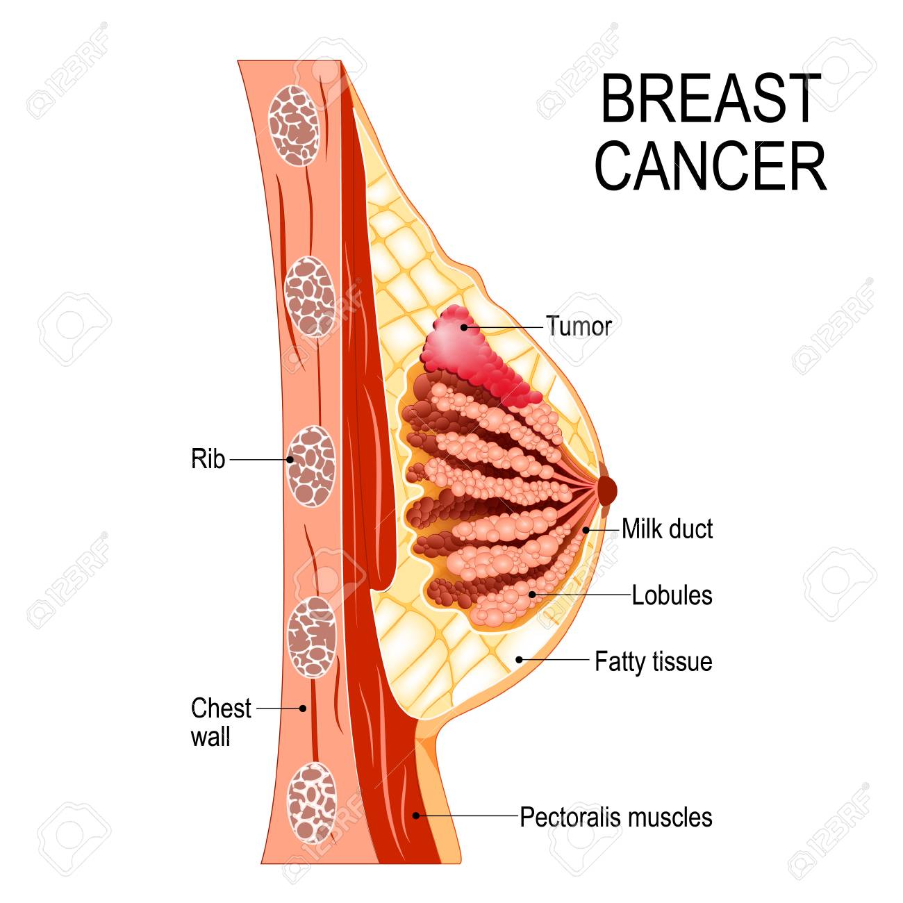 Prophylactic Mastectomy surgery cost in Bangalore – Find the Best Surgeons, Reviews and Book Appointment