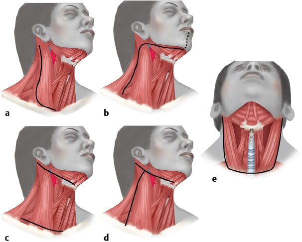 modified-neck-dissection-surgery-cost-in-bangalore-find-the-best