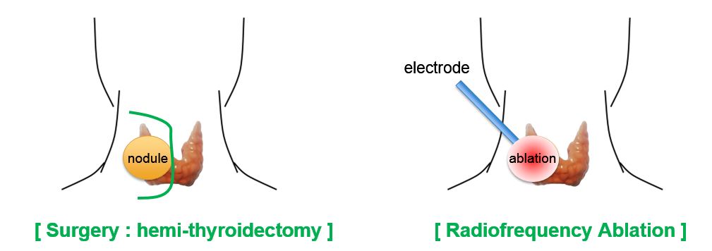 Loboisthmectomy surgery cost in Bangalore – Find the Best Surgeons, Reviews and Book Appointment