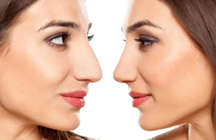 Rhinoplasty Cost in Chennai – Find the Best Surgeons, Reviews and Book Appointment