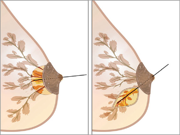 Microdochectomy surgery cost in Bangalore – Find the Best Surgeons, Reviews and Book Appointment