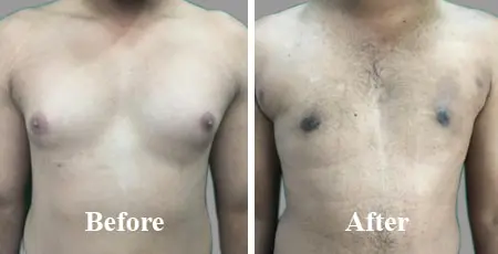 Gynecomastia Cost in Chennai – Find the Best Surgeons, Reviews and Book Appointment
