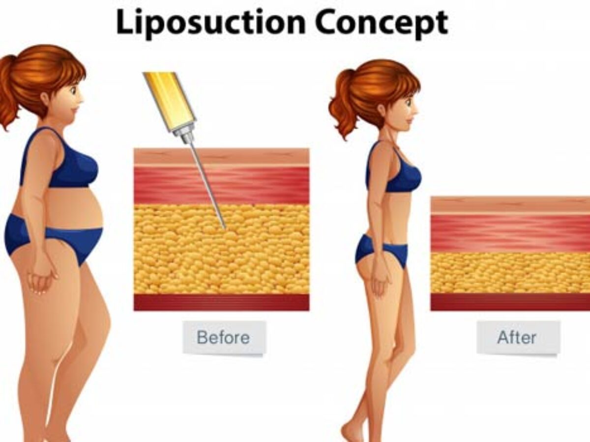 Liposuction Cost In Hyderabad Find The Best Surgeons Reviews And Book Appointment