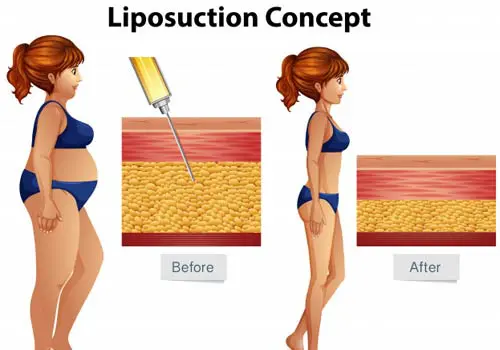 Liposuction Cost in Hyderabad – Find the Best Surgeons, Reviews and Book Appointment
